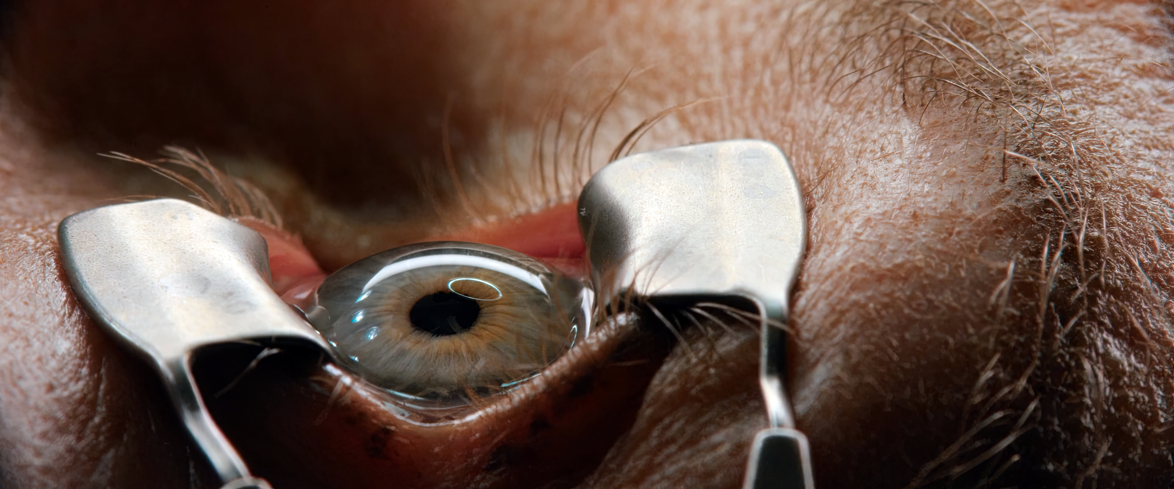 Векорасширитель для операций на глазах, Лазерная коррекция, Офтальмологический инструмент